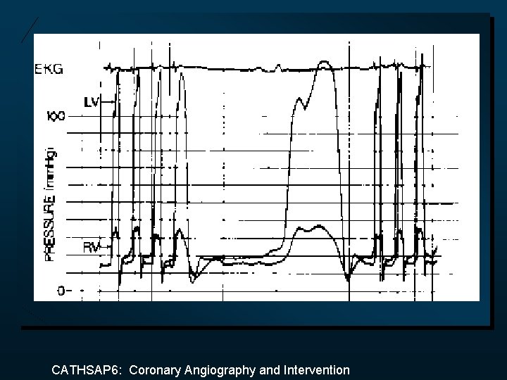 CATHSAP 6: Coronary Angiography and Intervention 