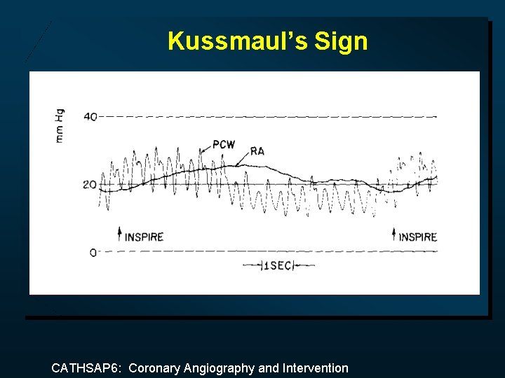 Kussmaul’s Sign CATHSAP 6: Coronary Angiography and Intervention 