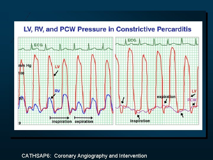 CATHSAP 6: Coronary Angiography and Intervention 