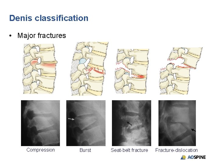 Classification and management of thoracolumbar fractures A summary