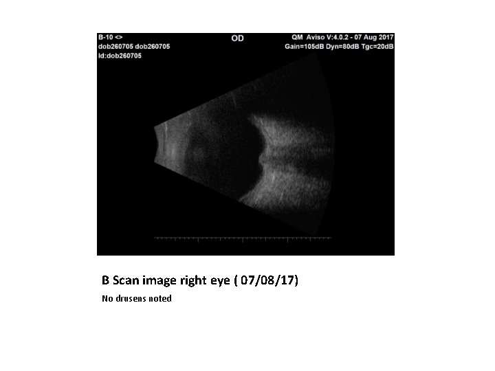 B Scan image right eye ( 07/08/17) No drusens noted B Scan image right eye ( 07/08/17) No drusens noted