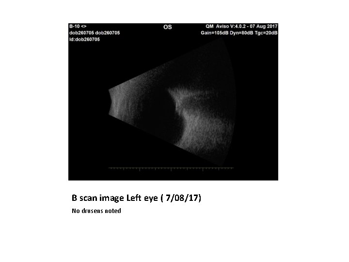 B scan image Left eye ( 7/08/17) No drusens noted B scan image Left eye ( 7/08/17) No drusens noted