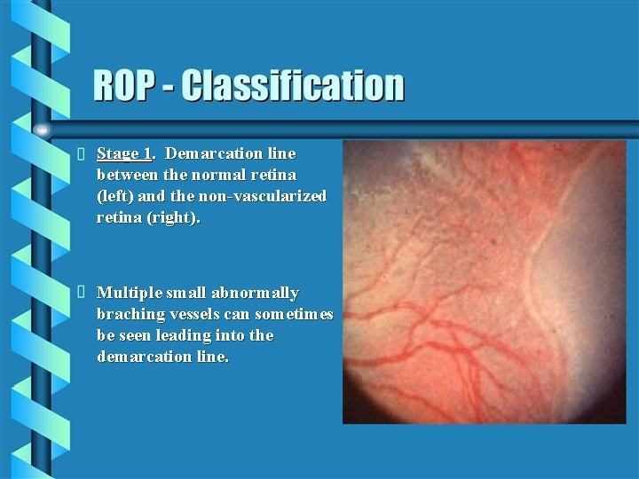 Stage 1. Demarcation line between the normal retina (left) and the non-vascularized retina (right).