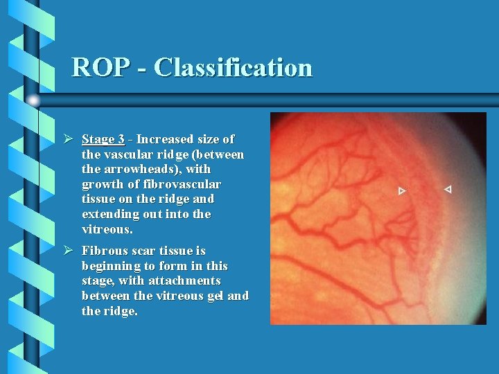 ROP - Classification Ø Stage 3 - Increased size of the vascular ridge (between