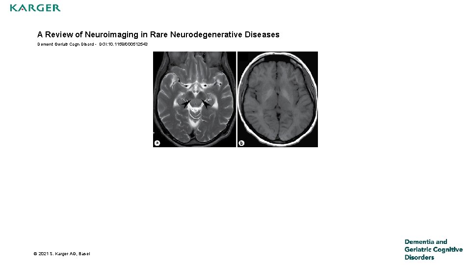 A Review of Neuroimaging in Rare Neurodegenerative Diseases Dement Geriatr Cogn Disord - DOI: