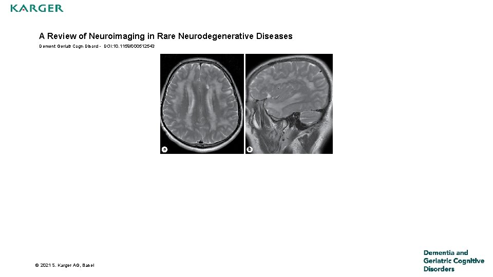 A Review of Neuroimaging in Rare Neurodegenerative Diseases Dement Geriatr Cogn Disord - DOI: