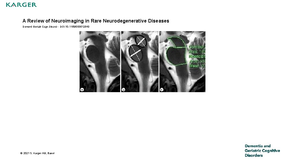 A Review of Neuroimaging in Rare Neurodegenerative Diseases Dement Geriatr Cogn Disord - DOI: