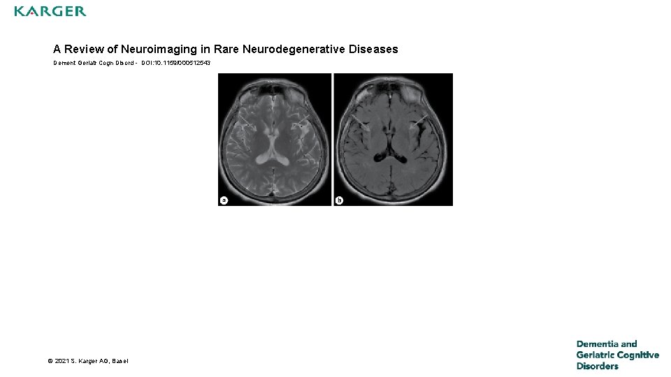 A Review of Neuroimaging in Rare Neurodegenerative Diseases Dement Geriatr Cogn Disord - DOI: