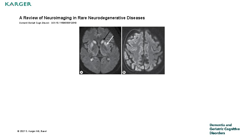 A Review of Neuroimaging in Rare Neurodegenerative Diseases Dement Geriatr Cogn Disord - DOI: