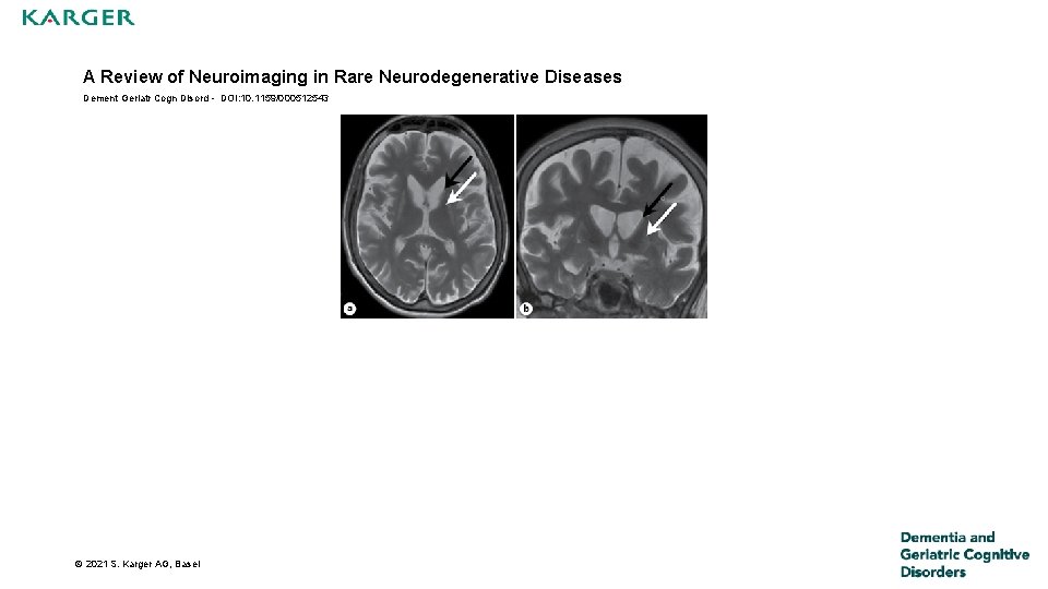 A Review of Neuroimaging in Rare Neurodegenerative Diseases Dement Geriatr Cogn Disord - DOI: