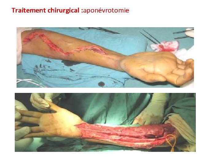 Traitement chirurgical : aponévrotomie 