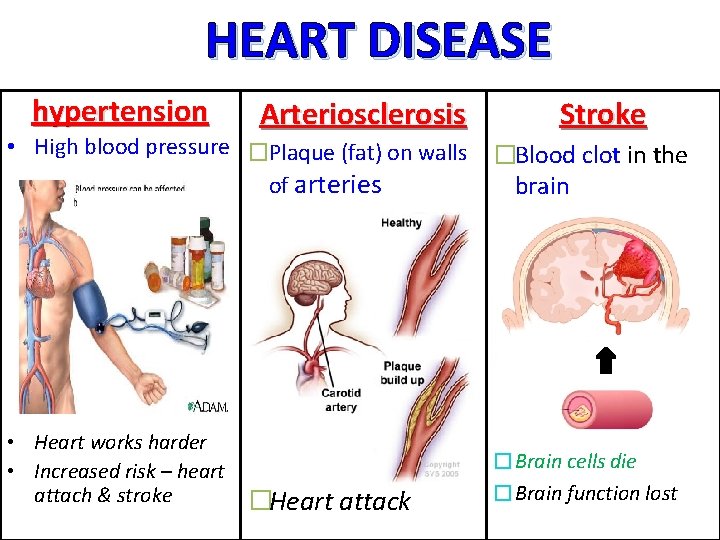 HEART DISEASE hypertension Arteriosclerosis Stroke • High blood pressure �Plaque (fat) on walls of