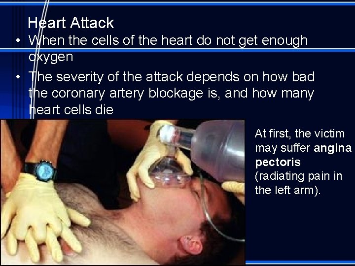 Heart Attack • When the cells of the heart do not get enough oxygen