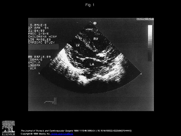 Fig. 1 The Journal of Thoracic and Cardiovascular Surgery 1996 111348 -358 DOI: (10.