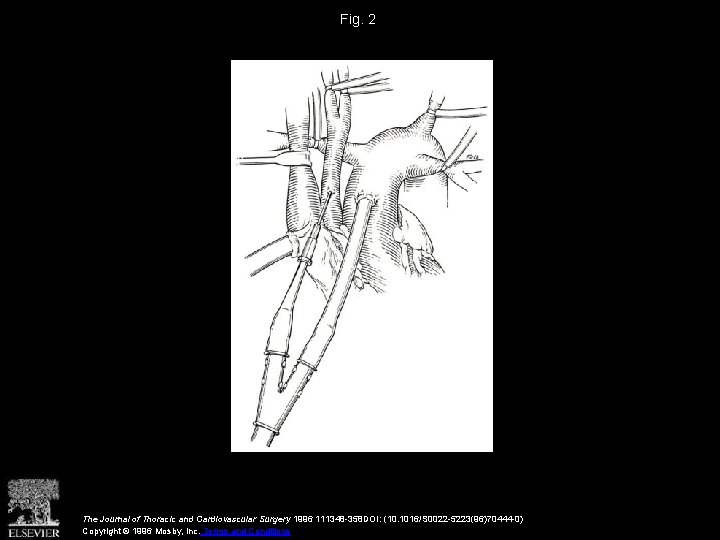 Fig. 2 The Journal of Thoracic and Cardiovascular Surgery 1996 111348 -358 DOI: (10.