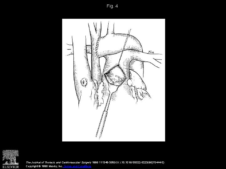 Fig. 4 The Journal of Thoracic and Cardiovascular Surgery 1996 111348 -358 DOI: (10.