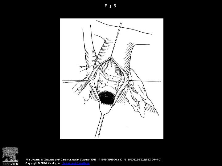 Fig. 5 The Journal of Thoracic and Cardiovascular Surgery 1996 111348 -358 DOI: (10.