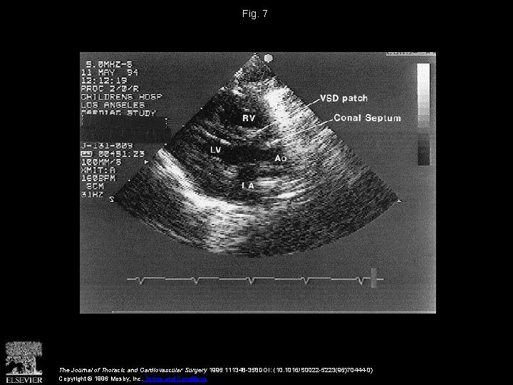 Fig. 7 The Journal of Thoracic and Cardiovascular Surgery 1996 111348 -358 DOI: (10.