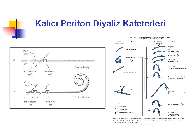 Kalıcı Periton Diyaliz Kateterleri 