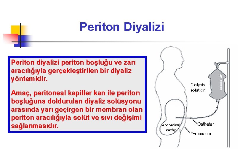 Periton Diyalizi Periton diyalizi periton boşluğu ve zarı aracılığıyla gerçekleştirilen bir diyaliz yöntemidir. Amaç,