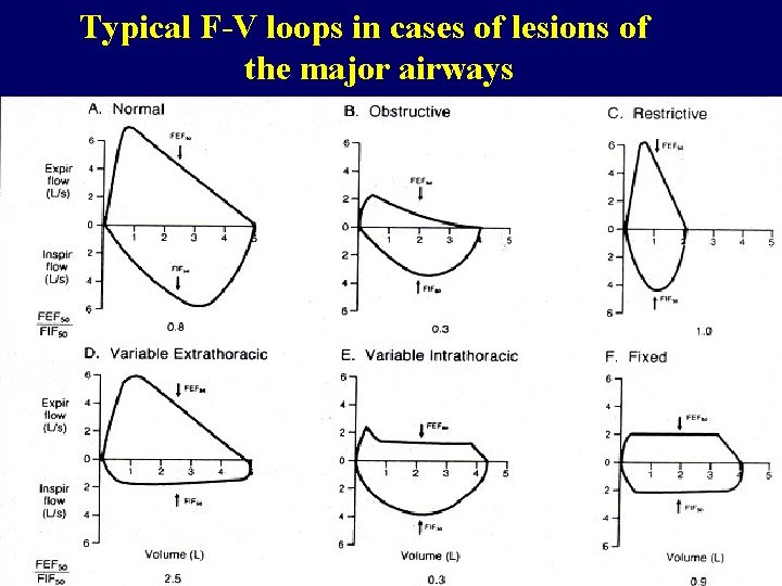 Typical F-V loops in cases of lesions of the major airways 