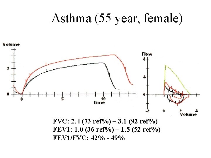 Asthma (55 year, female) FVC: 2. 4 (73 ref%) – 3. 1 (92 ref%)