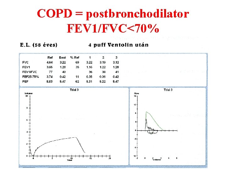 COPD = postbronchodilator FEV 1/FVC<70% 