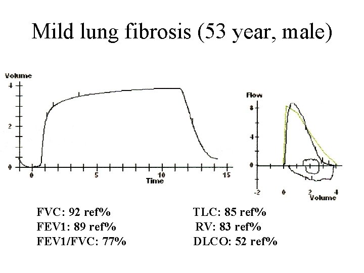 Mild lung fibrosis (53 year, male) FVC: 92 ref% FEV 1: 89 ref% FEV
