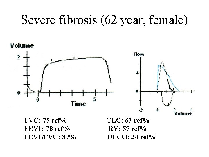 Severe fibrosis (62 year, female) FVC: 75 ref% FEV 1: 78 ref% FEV 1/FVC: