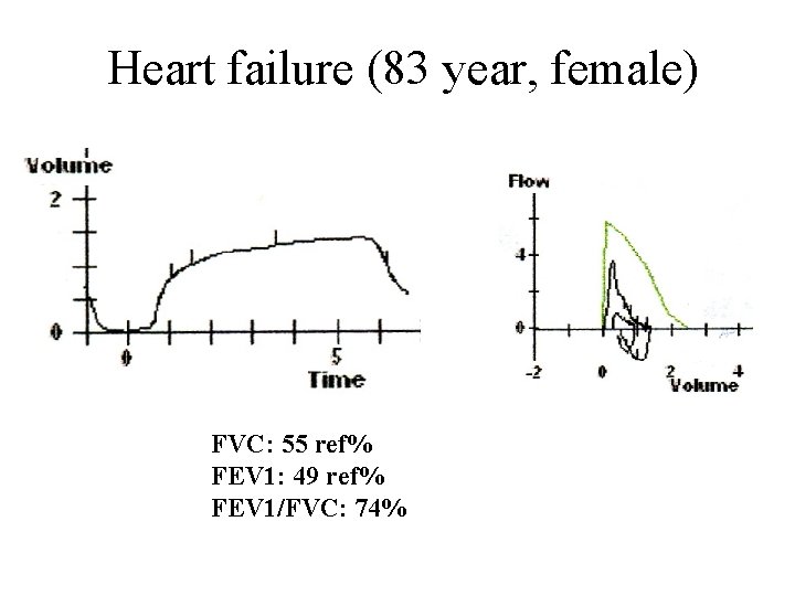 Heart failure (83 year, female) FVC: 55 ref% FEV 1: 49 ref% FEV 1/FVC: