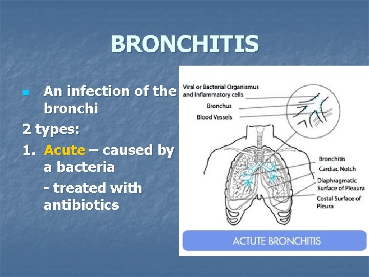 BRONCHITIS An infection of the bronchi 2 types: 1. Acute – caused by a