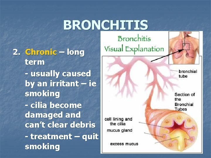 BRONCHITIS 2. Chronic – long term - usually caused by an irritant – ie
