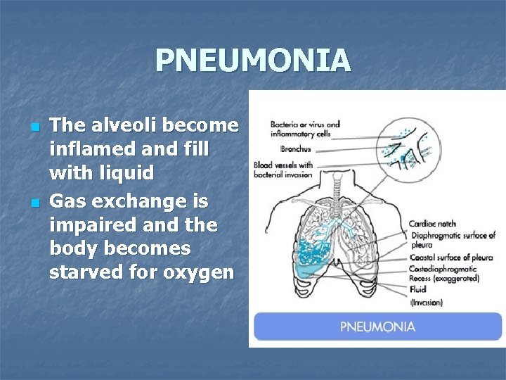 PNEUMONIA n n The alveoli become inflamed and fill with liquid Gas exchange is