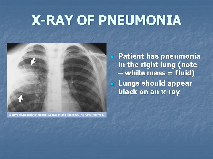 X-RAY OF PNEUMONIA n n Patient has pneumonia in the right lung (note –