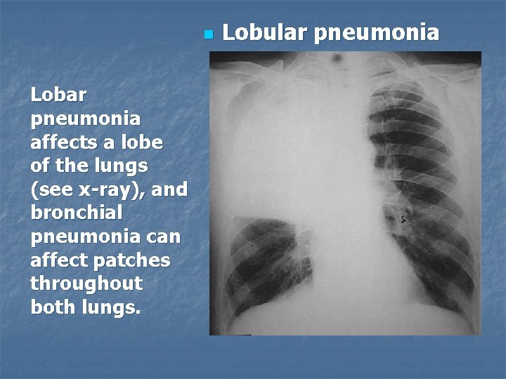 n Lobar pneumonia affects a lobe of the lungs (see x-ray), and bronchial pneumonia