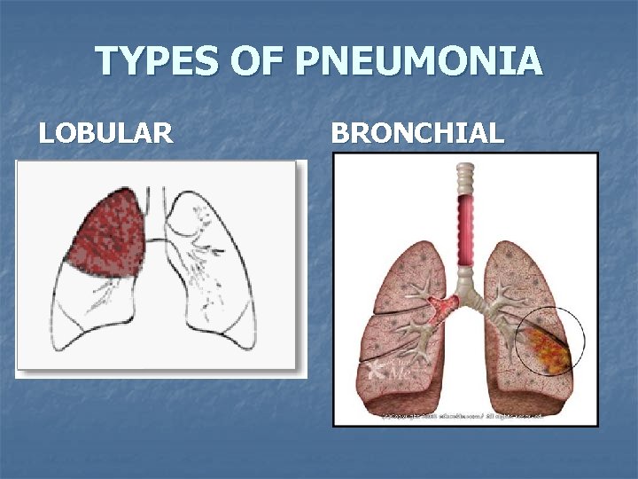 TYPES OF PNEUMONIA LOBULAR BRONCHIAL 