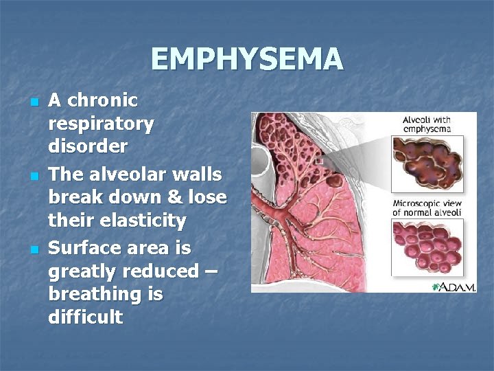 EMPHYSEMA n n n A chronic respiratory disorder The alveolar walls break down &