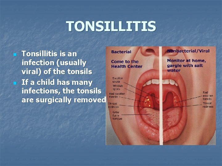 TONSILLITIS n n Tonsillitis is an infection (usually viral) of the tonsils If a