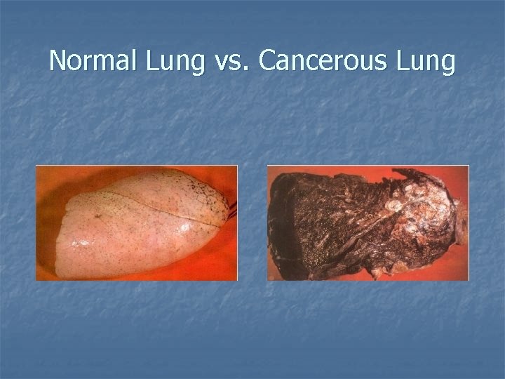 Normal Lung vs. Cancerous Lung 