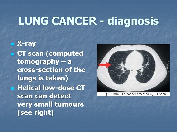 LUNG CANCER - diagnosis n n n X-ray CT scan (computed tomography – a