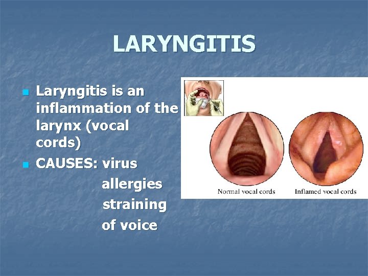 LARYNGITIS n n Laryngitis is an inflammation of the larynx (vocal cords) CAUSES: virus