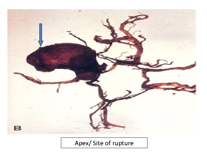 Cerebrovascular Diseases 2 CNS Trauma IISubarachnoid Hemorrhage Causes