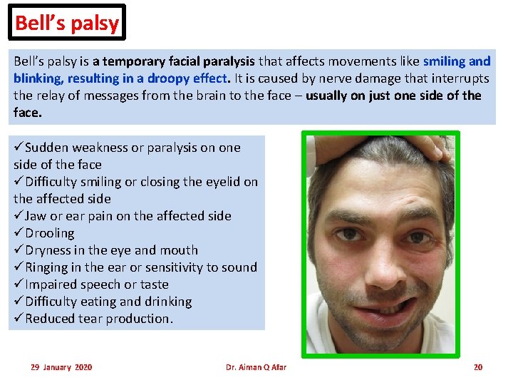 Bell’s palsy is a temporary facial paralysis that affects movements like smiling and blinking, Bell’s palsy is a temporary facial paralysis that affects movements like smiling and blinking,