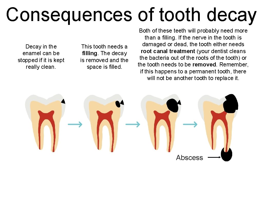 Consequences of tooth decay Decay in the enamel can be stopped if it is