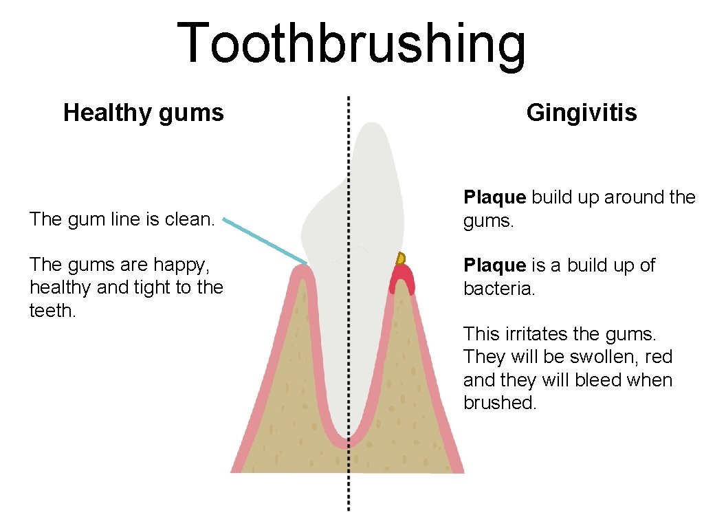 Toothbrushing Healthy gums The gum line is clean. The gums are happy, healthy and Toothbrushing Healthy gums The gum line is clean. The gums are happy, healthy and