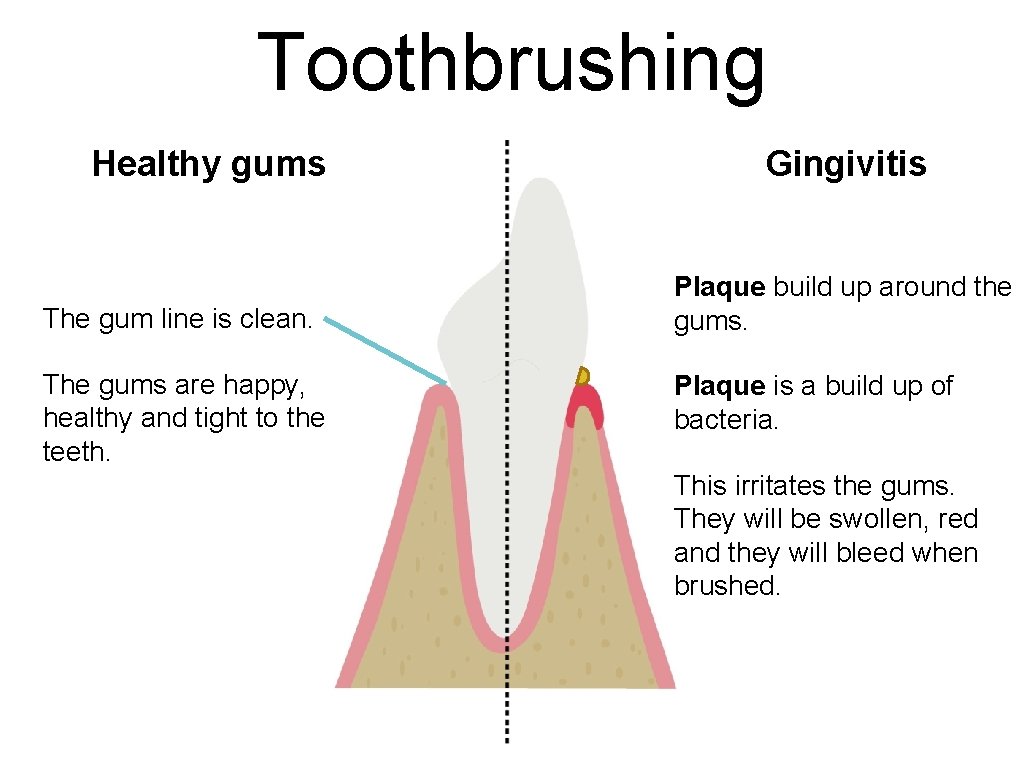 Toothbrushing Healthy gums The gum line is clean. The gums are happy, healthy and