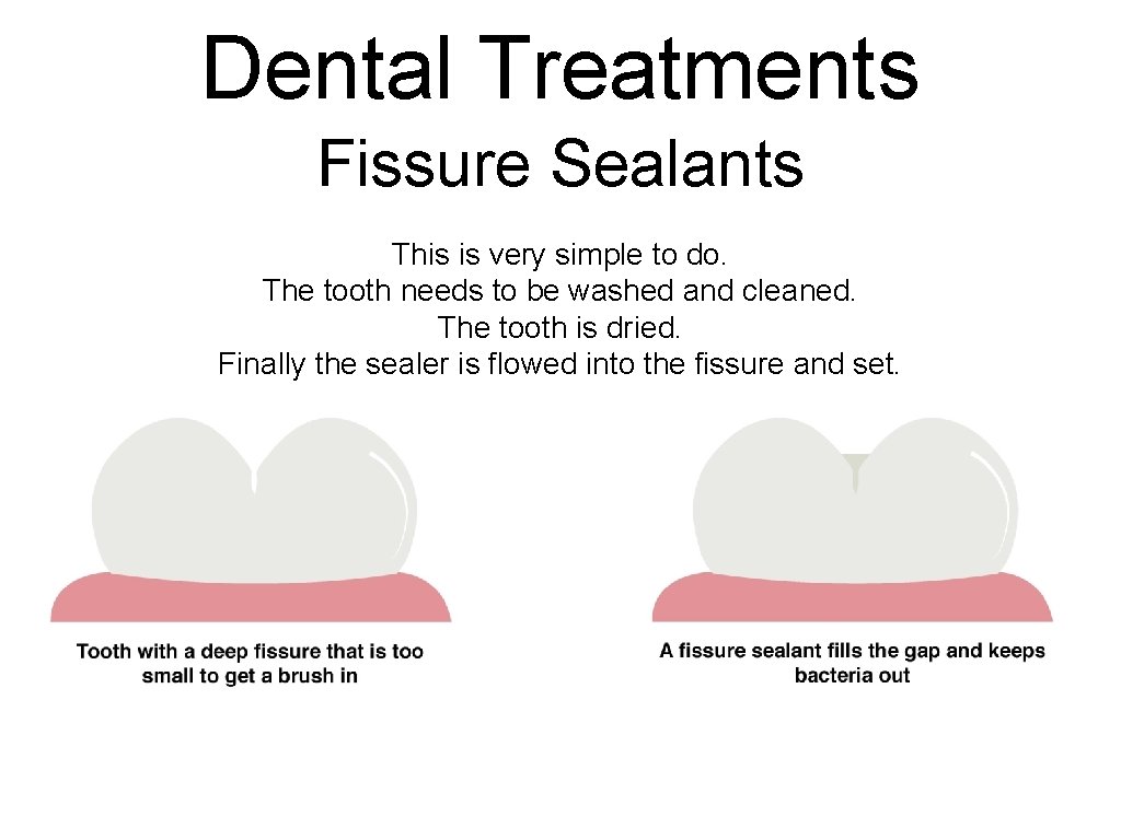 Dental Treatments Fissure Sealants This is very simple to do. The tooth needs to Dental Treatments Fissure Sealants This is very simple to do. The tooth needs to