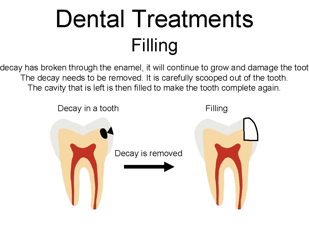 Dental Treatments Filling decay has broken through the enamel, it will continue to grow