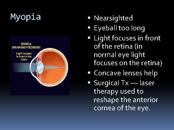 Myopia Nearsighted Eyeball too long Light focuses in front of the retina (in normal