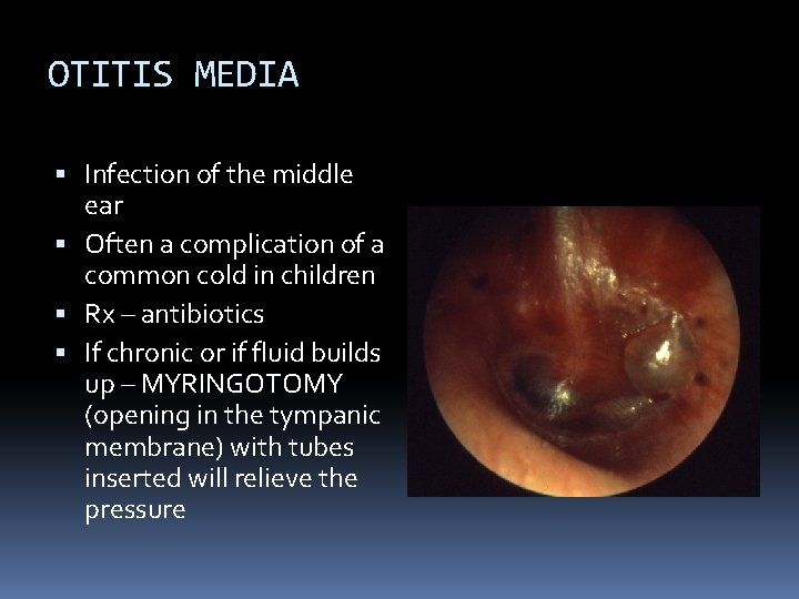 OTITIS MEDIA Infection of the middle ear Often a complication of a common cold